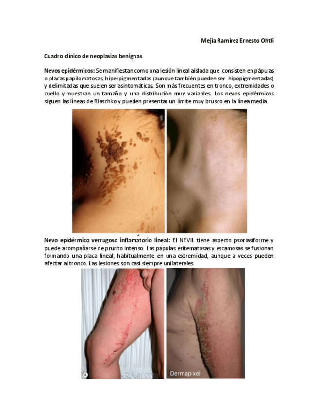 Miniatura del documento Neoplasias-Benignas-en-Dermatologia.pdf