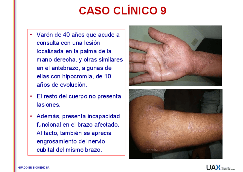 Miniatura del documento Caso-9-Mycobacterium-lepraeLepra-tuberculoide.pdf