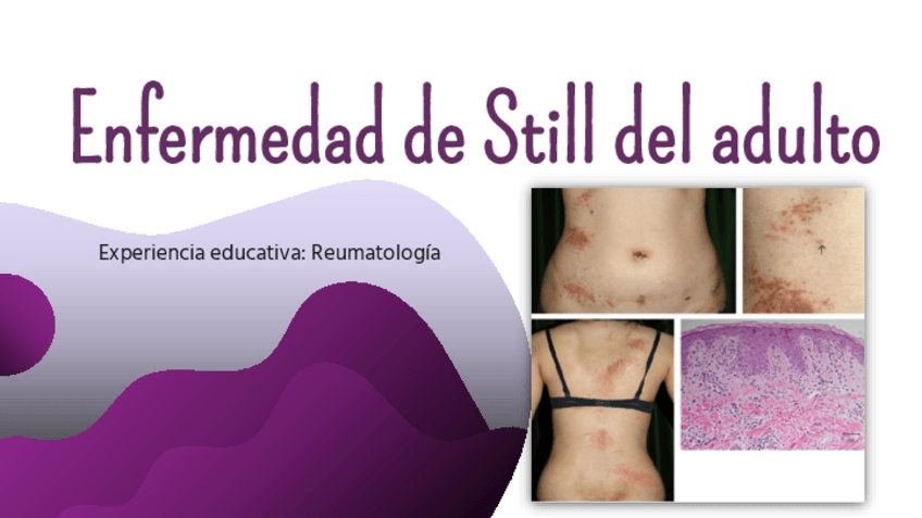 Miniatura del documento Enfermedad-Still-del-adulto.pdf