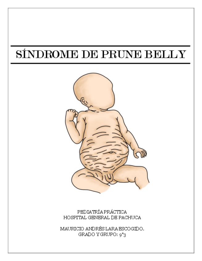 Miniatura del documento SINDROME-DE-PRUNE-BELLYRESUMEN-DE-ACTUALIZACIONES.pdf