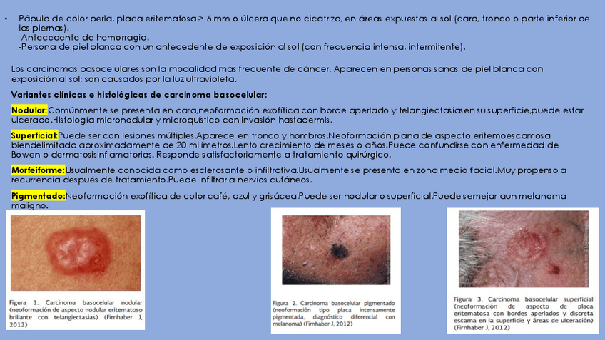 Miniatura del documento Carcinoma-basocelular.pdf