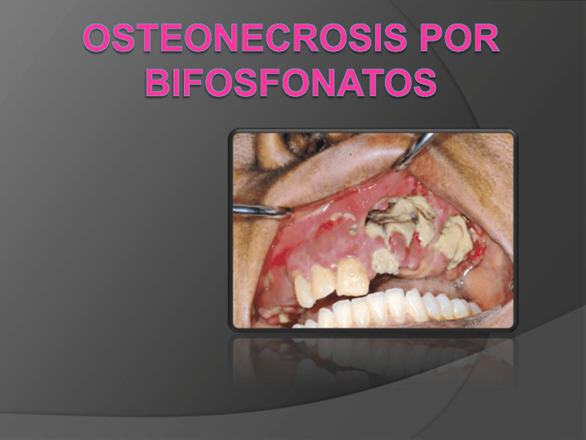 Miniatura del documento semi-bifosfonatos22.pdf