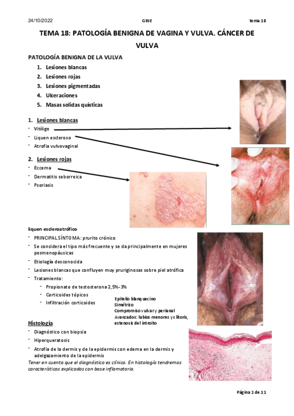 Miniatura del documento Tema-23.-Patologia-benigna-de-vagina-y-vulva.-Cancer-de-vulva-2.pdf