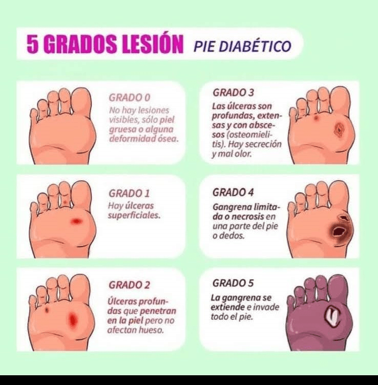 Miniatura del documento Pie-diabetico.jpg