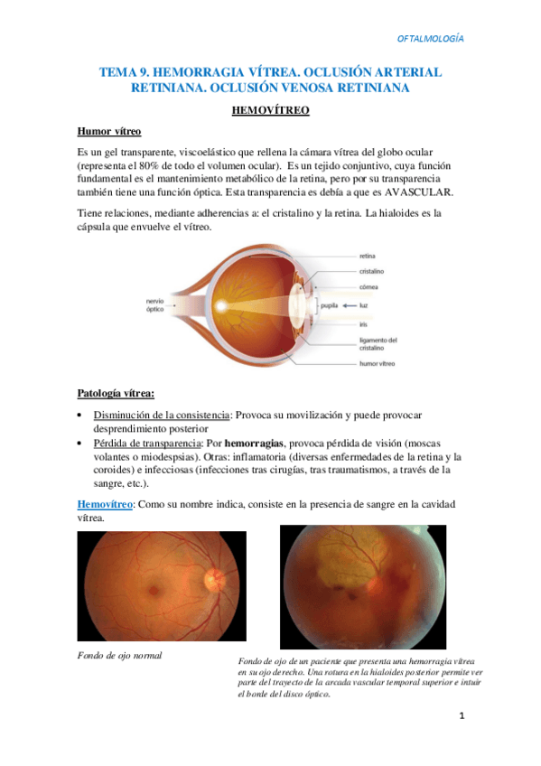Miniatura del documento T9.-Hemorragia-vitrea.-Oclusiones-vasculares.pdf