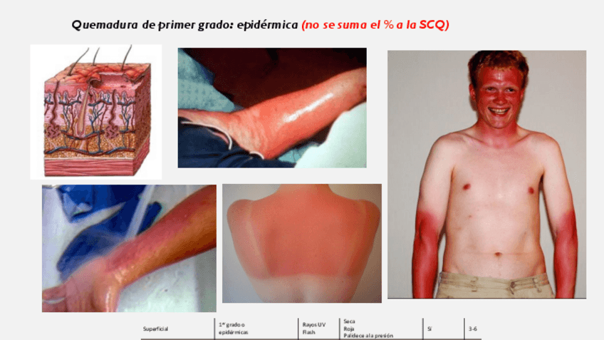 Miniatura del documento MQ-IV-92-Atencion-al-paciente-gran-quemado.pdf