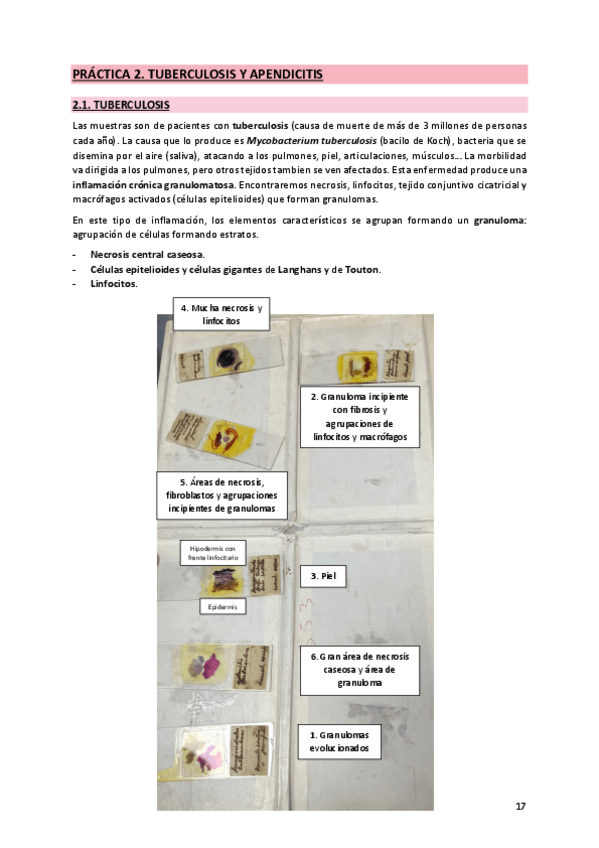 Miniatura del documento 2. Tuberculosis y apendicitis.pdf