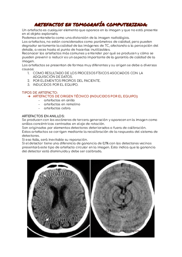 Miniatura del documento 10.-ARTEFACTOS-EN-TOMOGRAFIA-COMPUTERIZADA.pdf