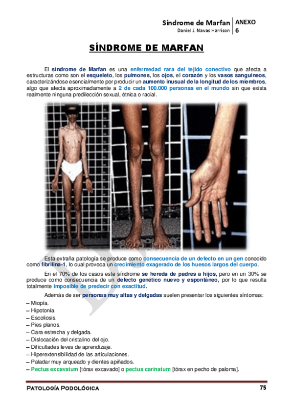 Miniatura del documento ANEXO-6o-Sindrome-de-Marfan.pdf